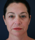 Feel Beautiful - Three Months After - Before Photo